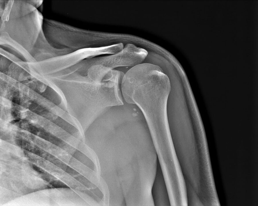 A vállízület 2. súlyossági foka arthrosisának röntgenfelvétele