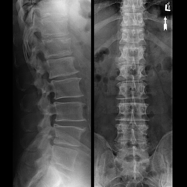 A mellkasi régió röntgenfelvétele, amely a csigolyák közötti rés csökkenését mutatja a gerinc mentén alulról felfelé