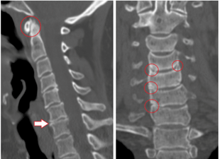 A CT vizsgálat a mellkasi osteochondrosis miatt sérült csigolyákat és heterogén magasságú lemezeket mutat
