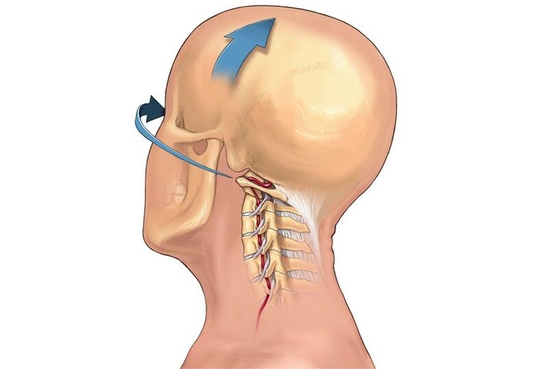 nyakroppanás a fej elfordításakor, mint a nyaki osteochondrosis tünete