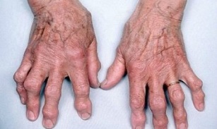 hogyan lehet megkülönböztetni az ujjak ízületi gyulladását az artrózistól