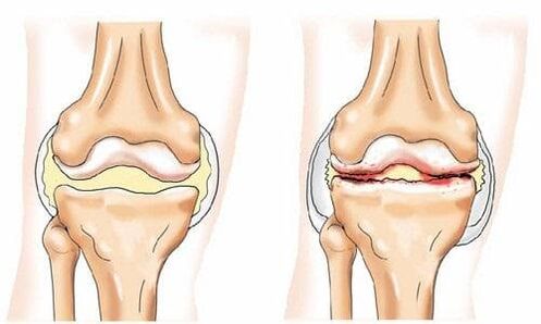 egészséges és arthrosisban érintett térdízület