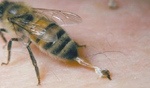 a csípőízület artrózisának kezelése méhek által