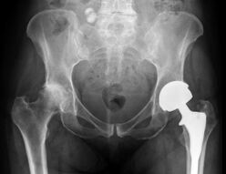 a csípőízület arthrosisának diagnózisa
