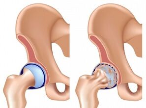 csípőízületi arthrosis tünetei