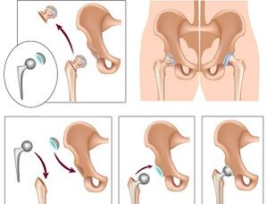 endoprotézis a csípőízület arthrosisához