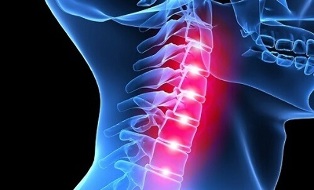 a nyaki gerinc osteochondrosisának megnyilvánulásai